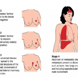 Breast Cancer Risk Elements