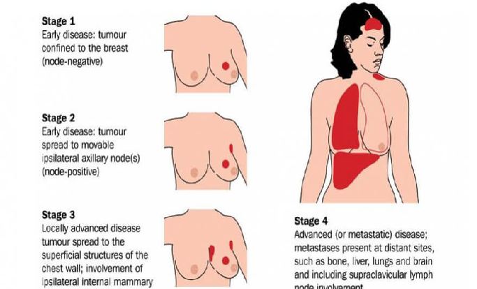 Breast Cancer Risk Elements